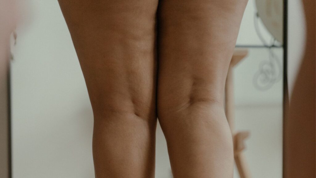 aceto di mele contro la cellulite